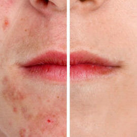 how to remove acne in photoshop phlearn