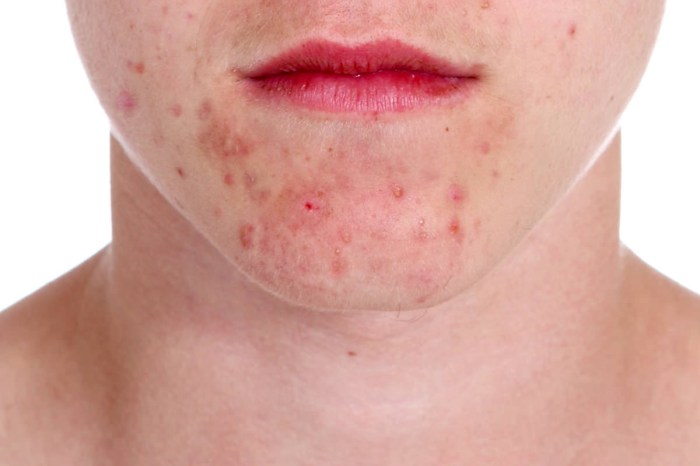 How to Remove Acne in Photoshop - PHLEARN