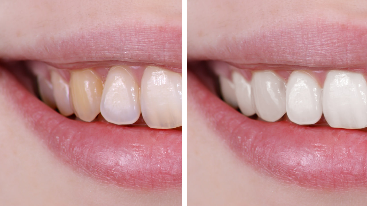 Teeth Whitening Prices - Can You Survive Keep In Mind This?
