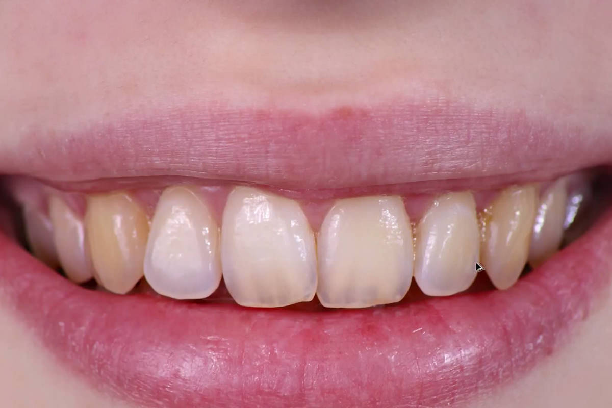 white teeth before