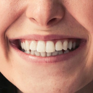 Close-up of a bright, white smile, demonstrating how to whiten teeth in Photoshop