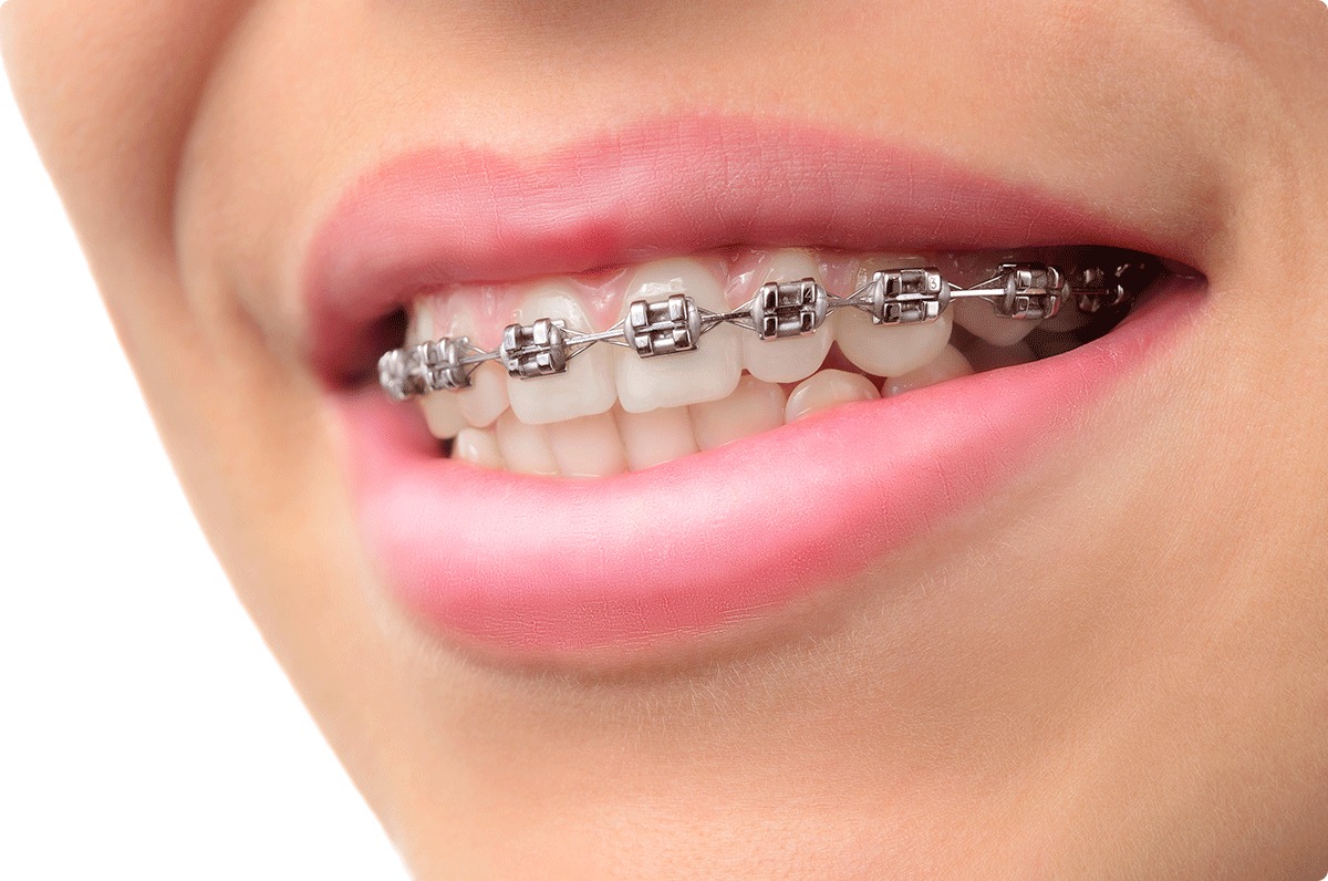 Close-up of a smile with metal braces on the teeth