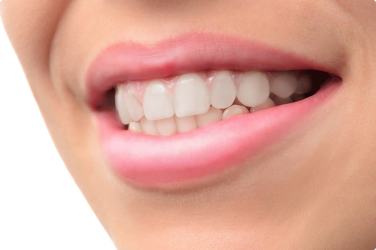 Close-up of a smile after braces were removed in Photoshop